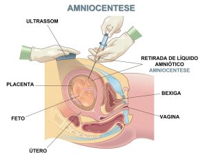 amniocentese para diagnóstico de síndromes genéticas relacionadas a hidrocefalia fetal
