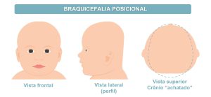 esquema mostrando braquicefalia posicional
