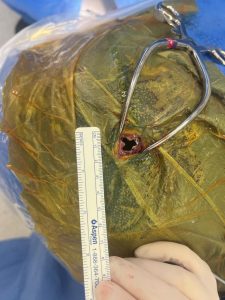 foto de uma cirurgia de cisto aracnoide por técnica mini-open