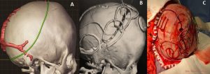 Cirurgia de cranioestenose técnica dinâmica - A- Planejamento cirúrgico em software 3d; B- Tomografia de controle pós-operatória mostrando execução conforme planejamento cirúrgico; C- Cirurgia com molas e osteotomias em nautilus. 