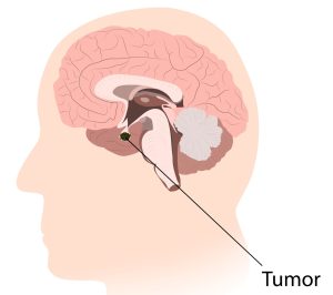 Imagens mostrando a localização dos craniofaringiomas