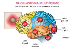 Distribuição em percentual no cérebro das localizações do glioblastoma multiforme. 