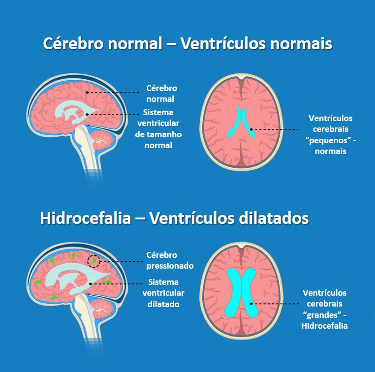 imagem gráfica demonstrando um cerebro normal e um cerebro com hidrocefalia
