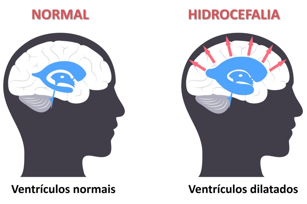 Hidrocefalia Do Adulto Dra Raquel Rodrigues Neurocirurgia Pediátrica 9585