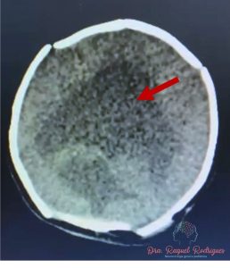 Tomografia de crânio de criança com holoprosencefalia - um tipo de malformação no sistema nervoso