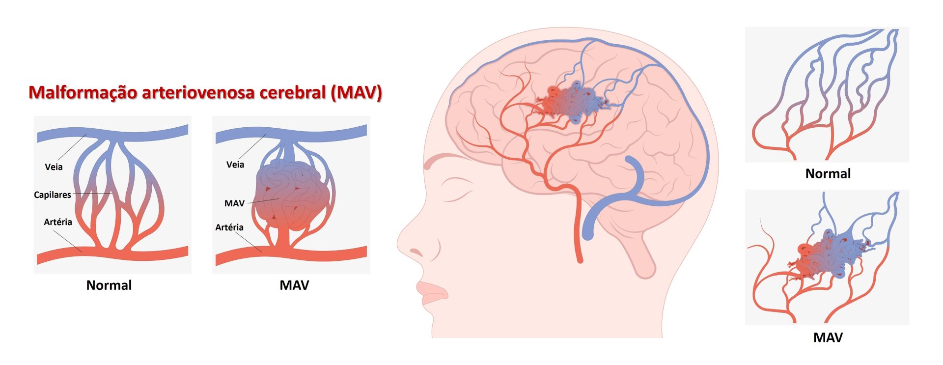 Malformação Artério-Venosa - Dra. Raquel Rodrigues - Neurocirurgia ...