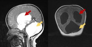 Imagens de RM de crânio de criança com Síndrome de Dandy-Walker