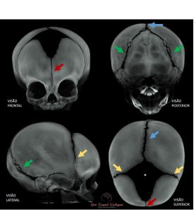 Imagens de tomografia computadorizada mostrando crânio de bebê normal com suturas cranianas abertas descartando cranioestenose