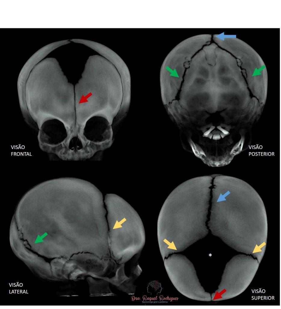 Cranioestenose - Dra. Raquel Rodrigues - Neurocirurgia pediátrica