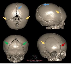 Tomografia computadorizada de crânio com reconstrução 3d de um bebê normal descartando diagnóstico de cranioestenose