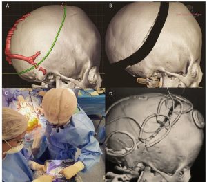 Diversas imagens mostrando uma cirurgia de cranioestenose complexa com uso de molas. 