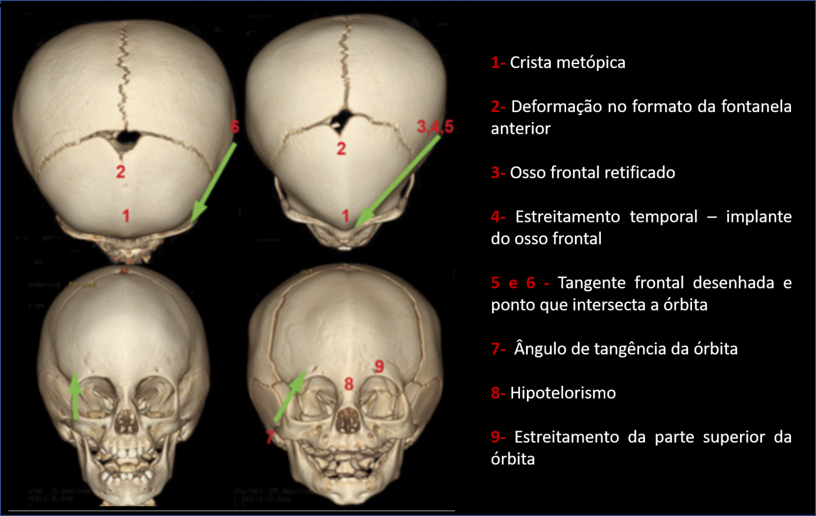 Tomografia 3D com sinais indicativos de trigonocefalia clássica. 