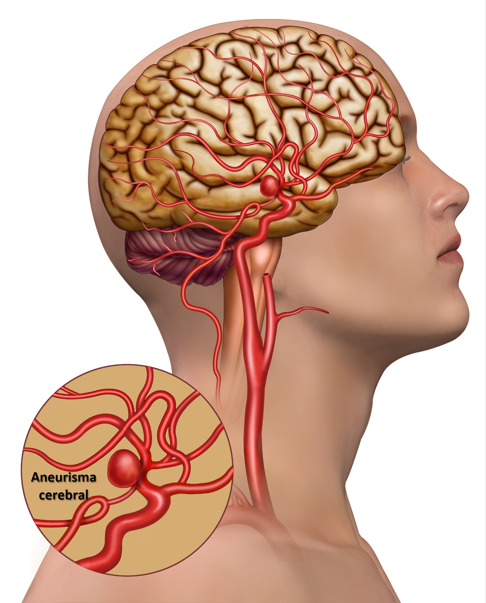 Aneurismas Cerebrais - Dra. Raquel Rodrigues - Neurocirurgia pediátrica