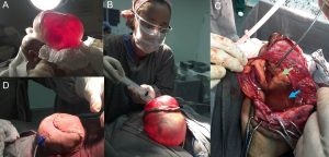 várias imagens de cirurgia de encefalocele occipital gigante. 