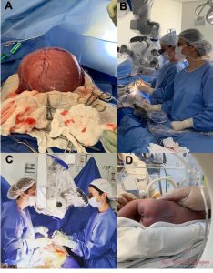 Imagens que mostram como é feita a cirurgia pré-natal (fetal) de mielomeningocele a céu aberto. 