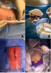 Cirurgia pós-natal de mielomeningocele - imagens de cirurgia
