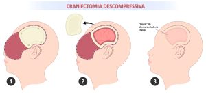 esquema demonstrando as etapas de uma craniotomia descompressiva