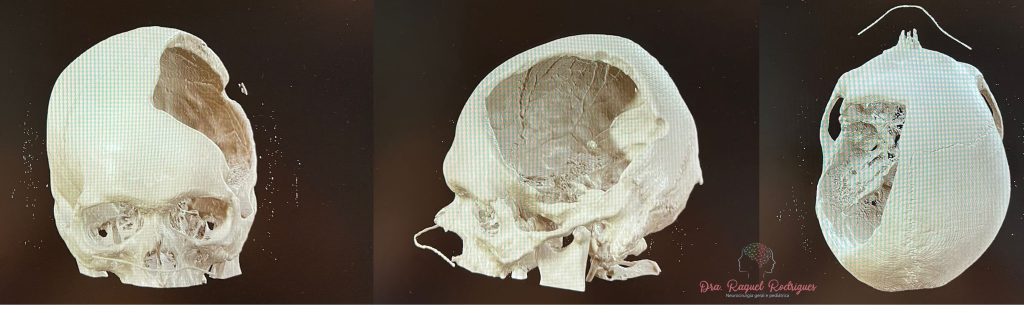reconstrução 3d de falha óssea no crânio após craniectomia descompressiva para avc.