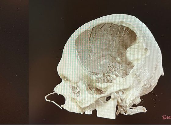 reconstrução 3d de falha óssea no crânio após craniectomia descompressiva para avc.