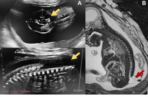 Ultrassonografia e Ressonância magnética fetal de 2 fetos com malformação na coluna descoberta durante avaliação pré-natal de rotina.