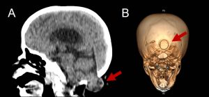 imagens de tomografia mostrando encefalocele occipital