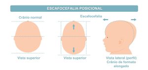 Imagem mostrando escafocefalia posicional. 