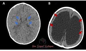 Tomografias de crânio de criança com ventrículo normal e com hidrocefalia. 