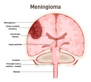 Localização dos meningiomas