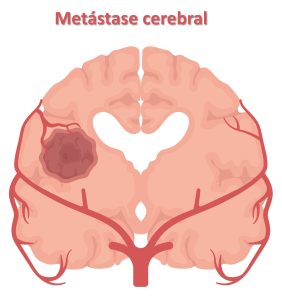 imagem mostrando metastases cerebrais hematogenicas