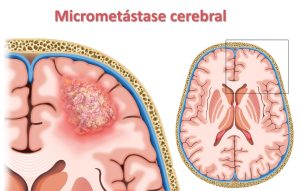 micro metastases cerebrais