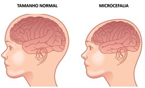 imagem demonstrando o que acontece com o crânio na microcefalia
