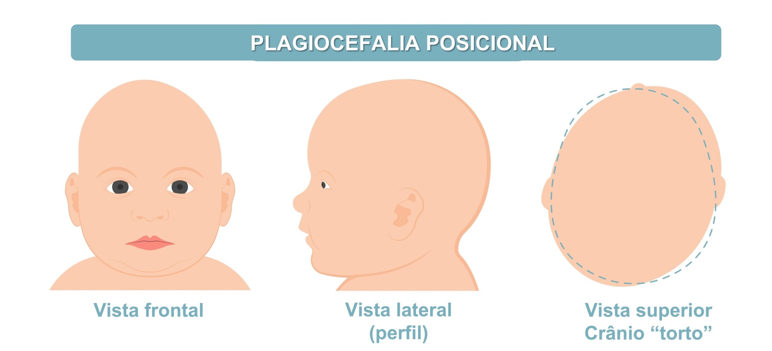 desenho da cabeça de um bebê com plagiocefalia posicional