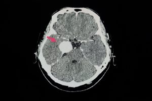 meningiomas no seio cavernoso - tc de crânio evidenciando meningioma cerebral nesta localização
