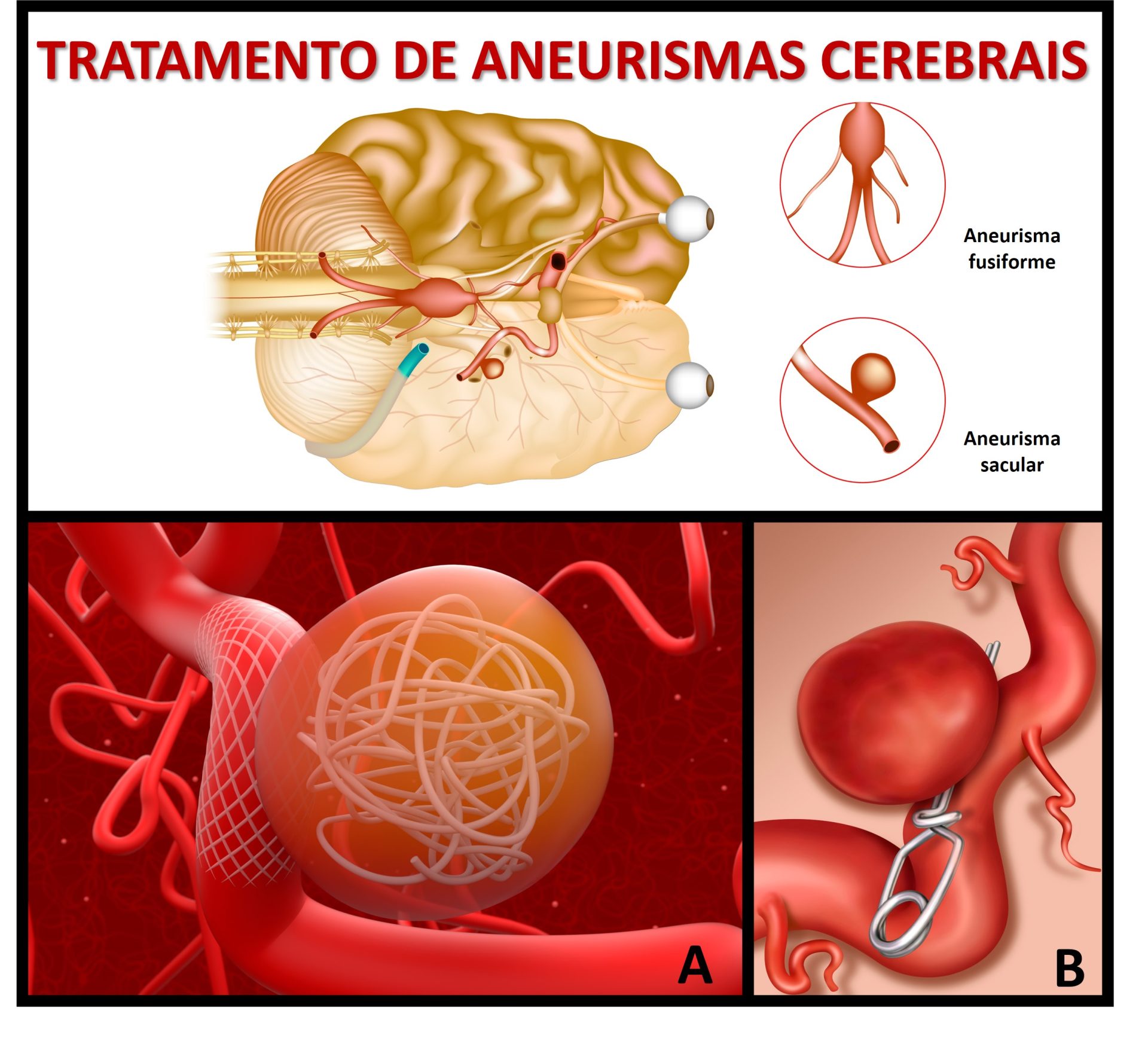 Aneurismas Cerebrais Dra Raquel Rodrigues Neurocirurgia Pediátrica 5209