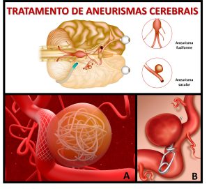 esquema mostrando tratamento de aneurismas cerebrais. 