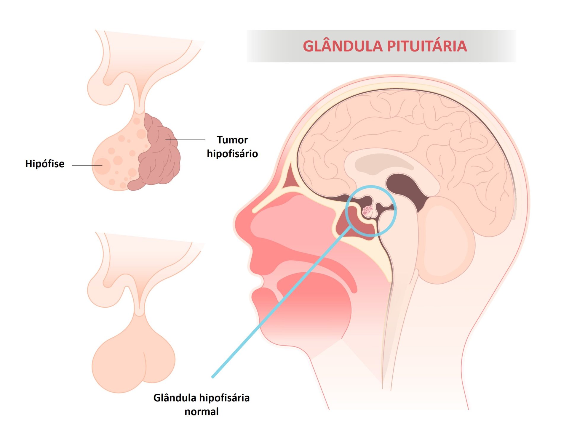 Tumores da glândula hipófise (Adenomas Hipofisários) - Dra. Raquel ...