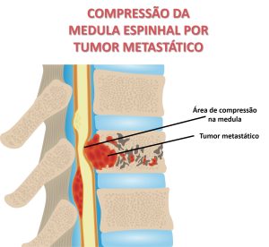 Metástases para coluna vertebral com compressão na medula espinhal