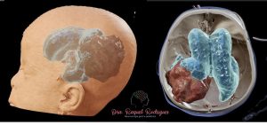 Imagens tridimensionais mostrando volumoso tumor ventricular com hidrocefalia em bebe. 