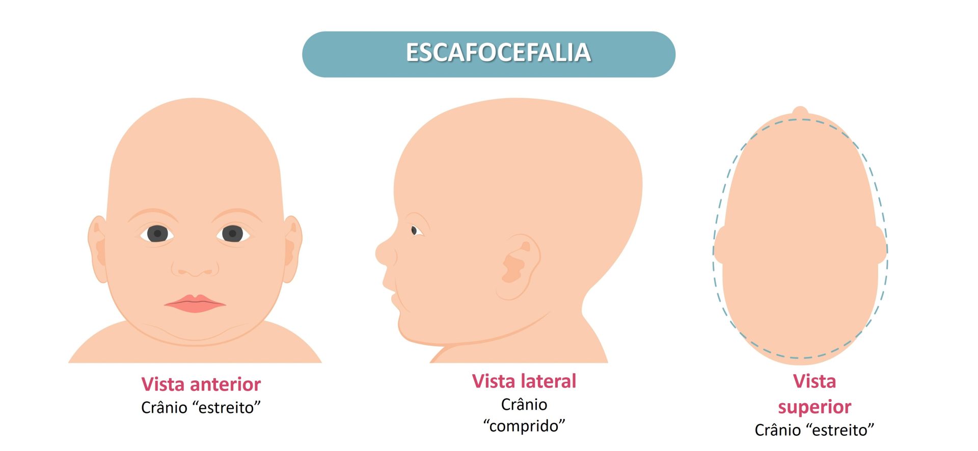 Escafocefalia - Dra. Raquel Rodrigues - Neurocirurgia pediátrica