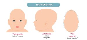 esquema demonstrando principais características do crânio com escafocefalia. 