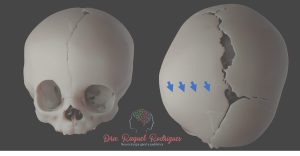 reconstrução 3d evidenciando caso de cranioestenose plagiocefalia anterior
