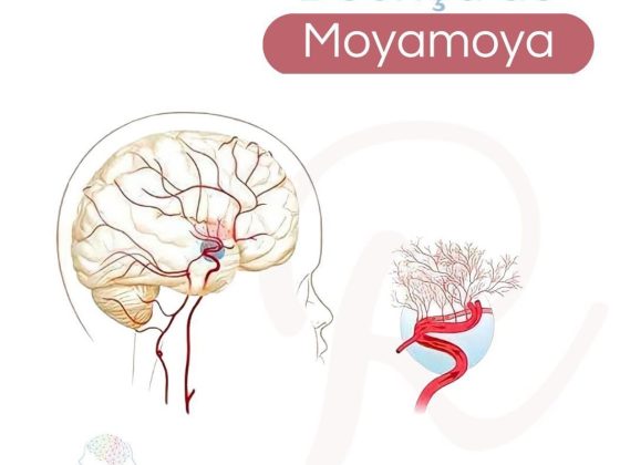 moyamoya
