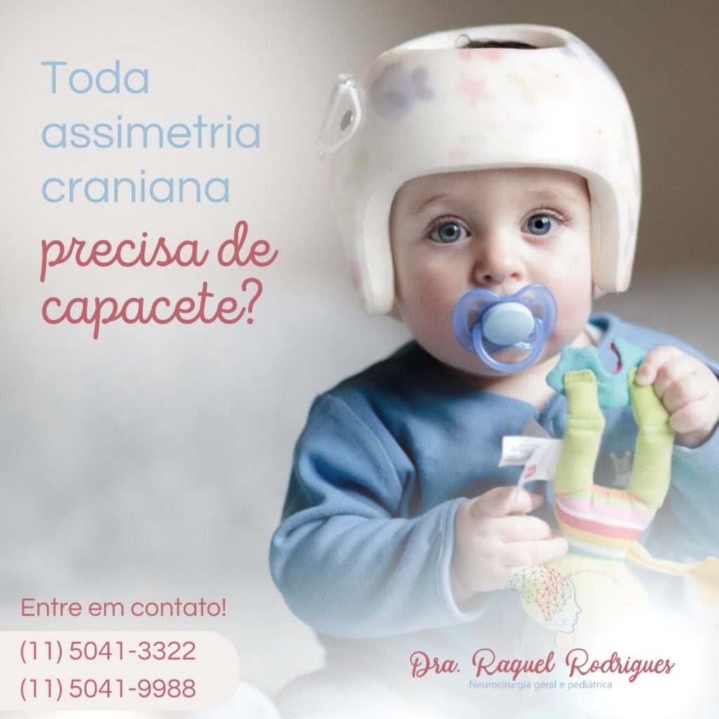 Toda Assimetria craniana precisa do uso de capacete