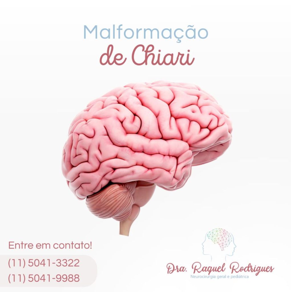 o que é a malformação de chiari