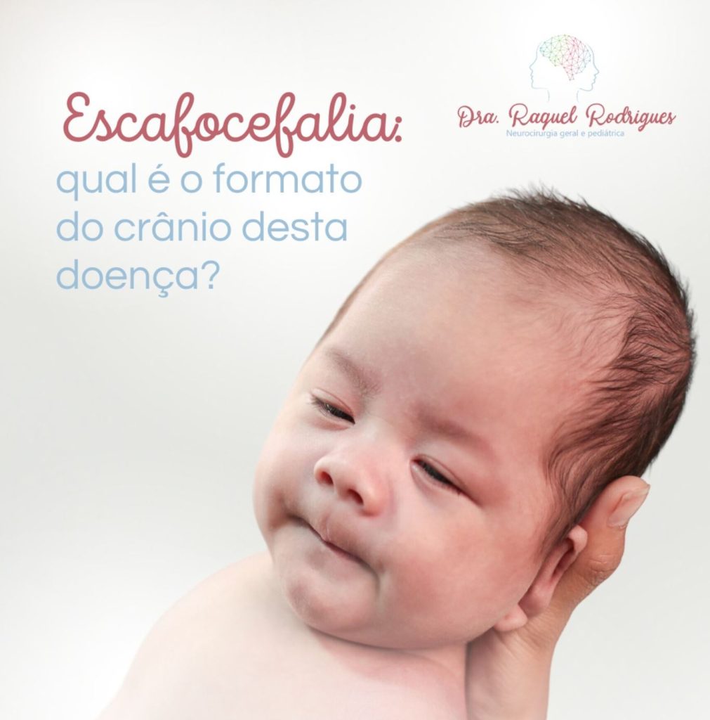 como é o crânio da escafocefalia