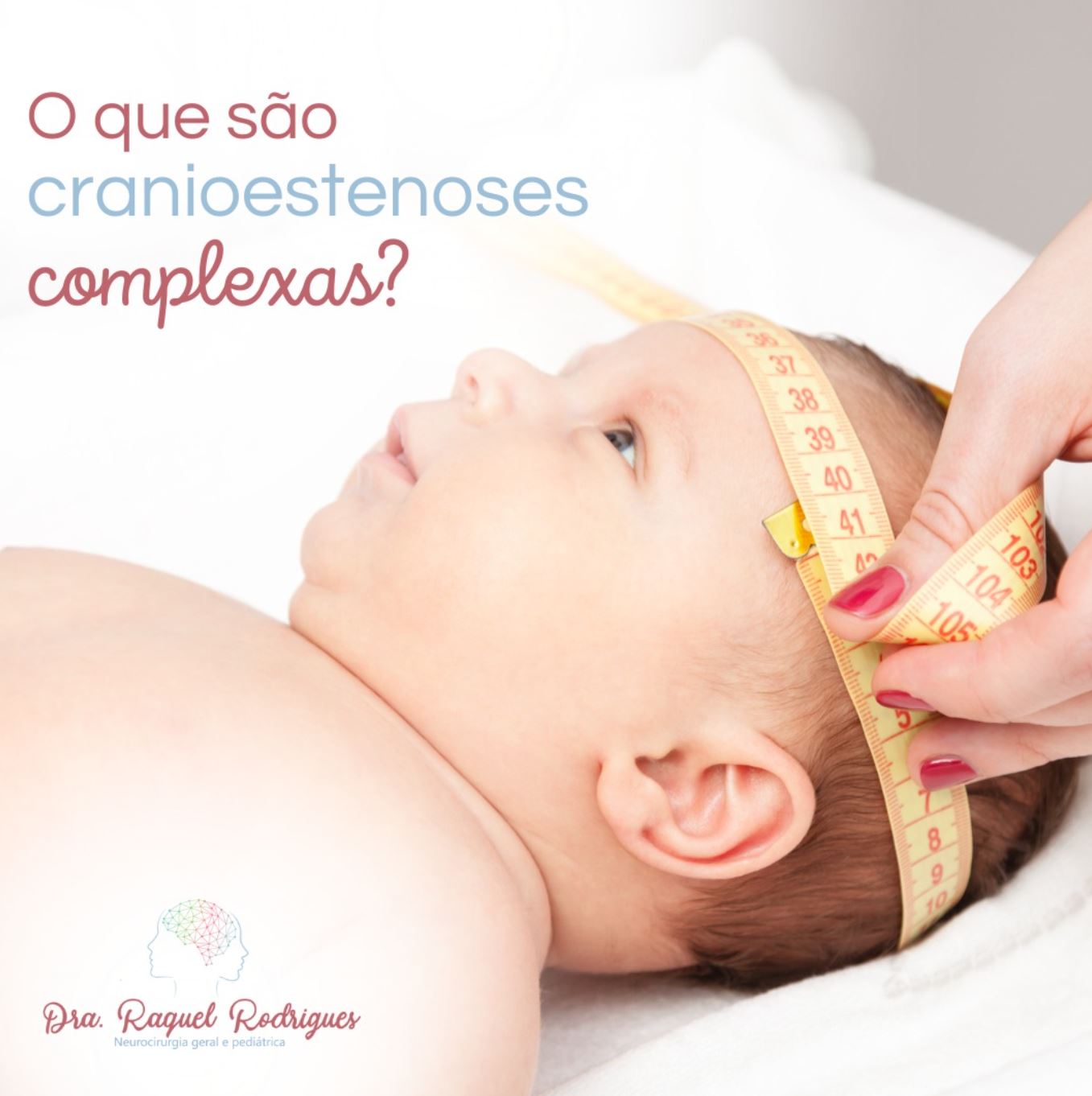 O que é cranioestenose complexa? - Dra. Raquel Rodrigues ...
